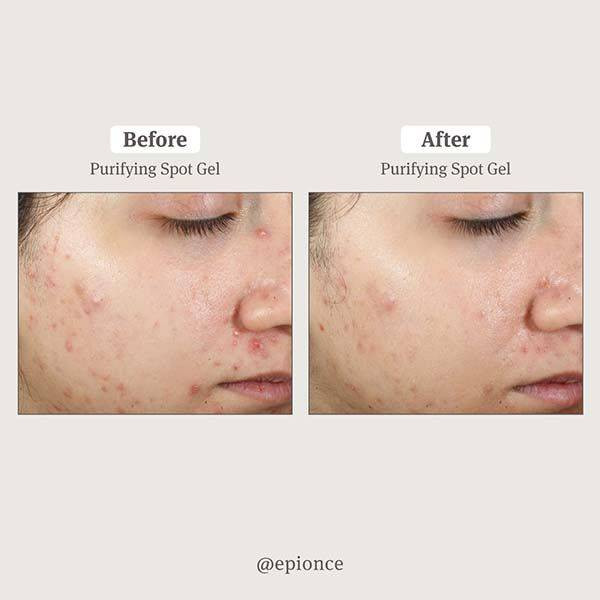 Before and after photos of acne on cheek with epionce Purifying Spot Gel