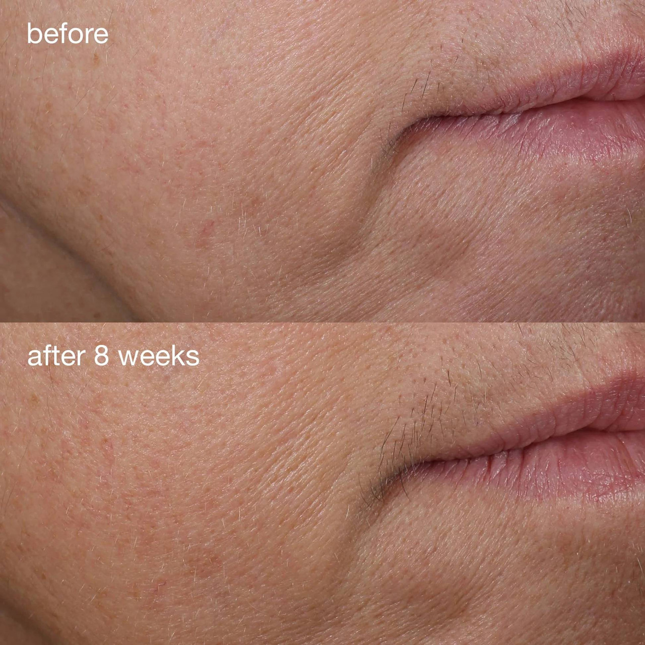 Before and after 8 weeks close-up photos of smile lines