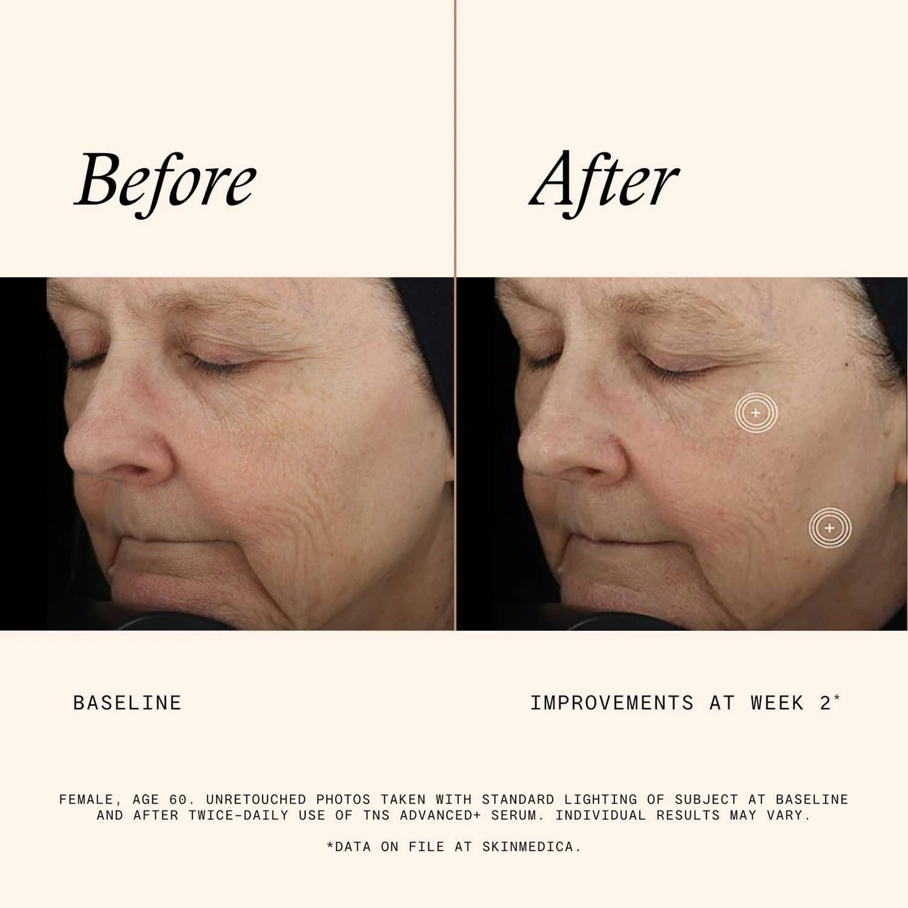 SkinMedica TNS Advanced+ Serum before and after week 2 face photos