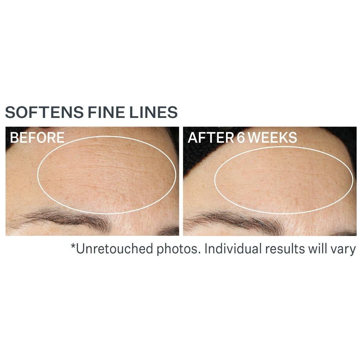 Forehead before and after 6 weeks comparison photos
