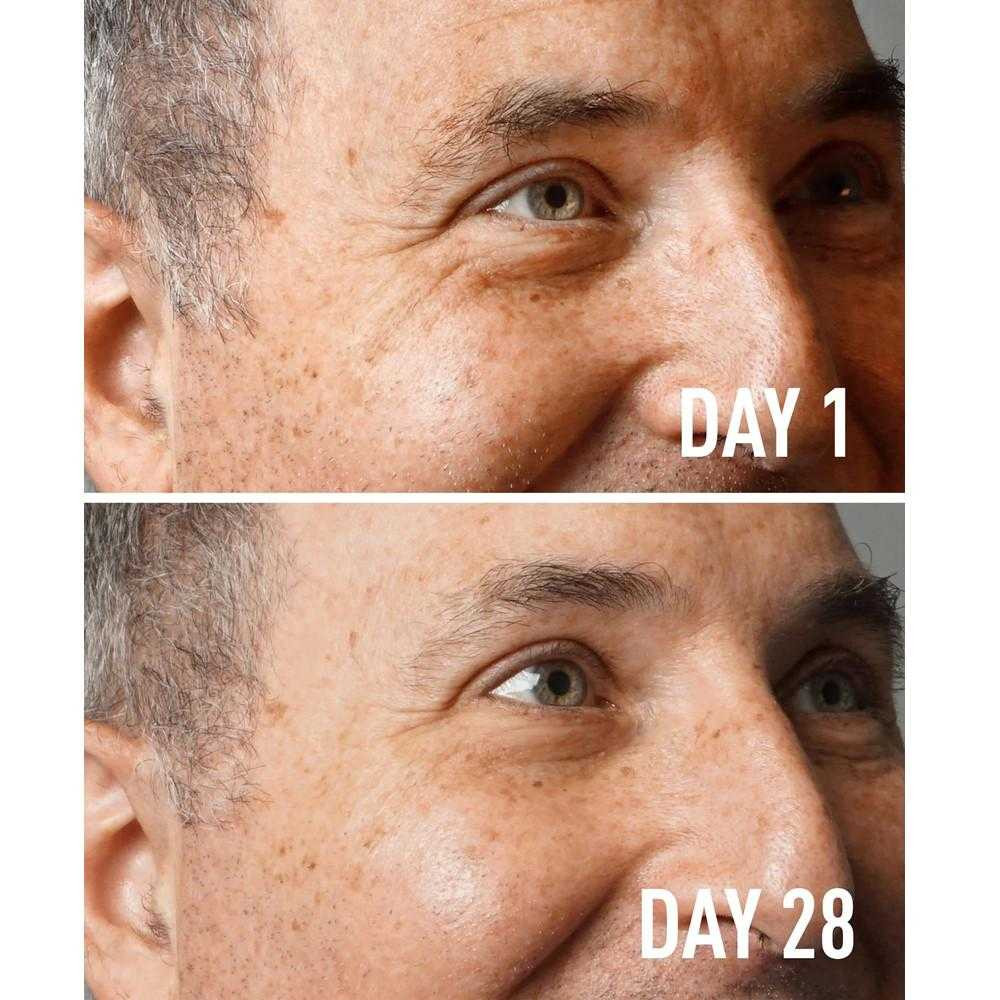 Man's face shown at day 1 and day 28