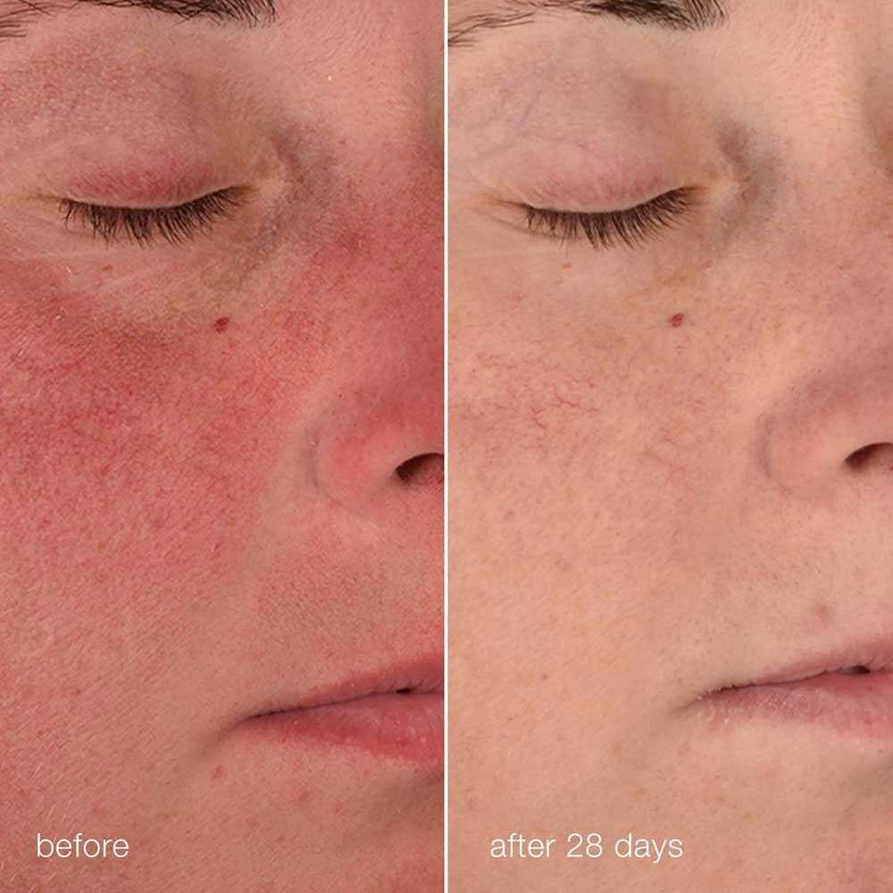 Before and after 28 days: cheek redness visibly reduced