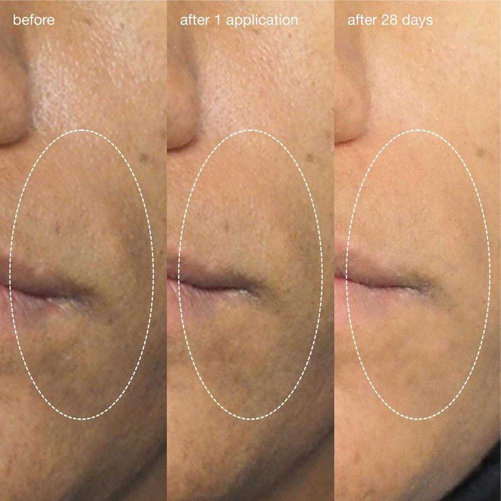 Before, after 1 application and after 28 days cheek photos