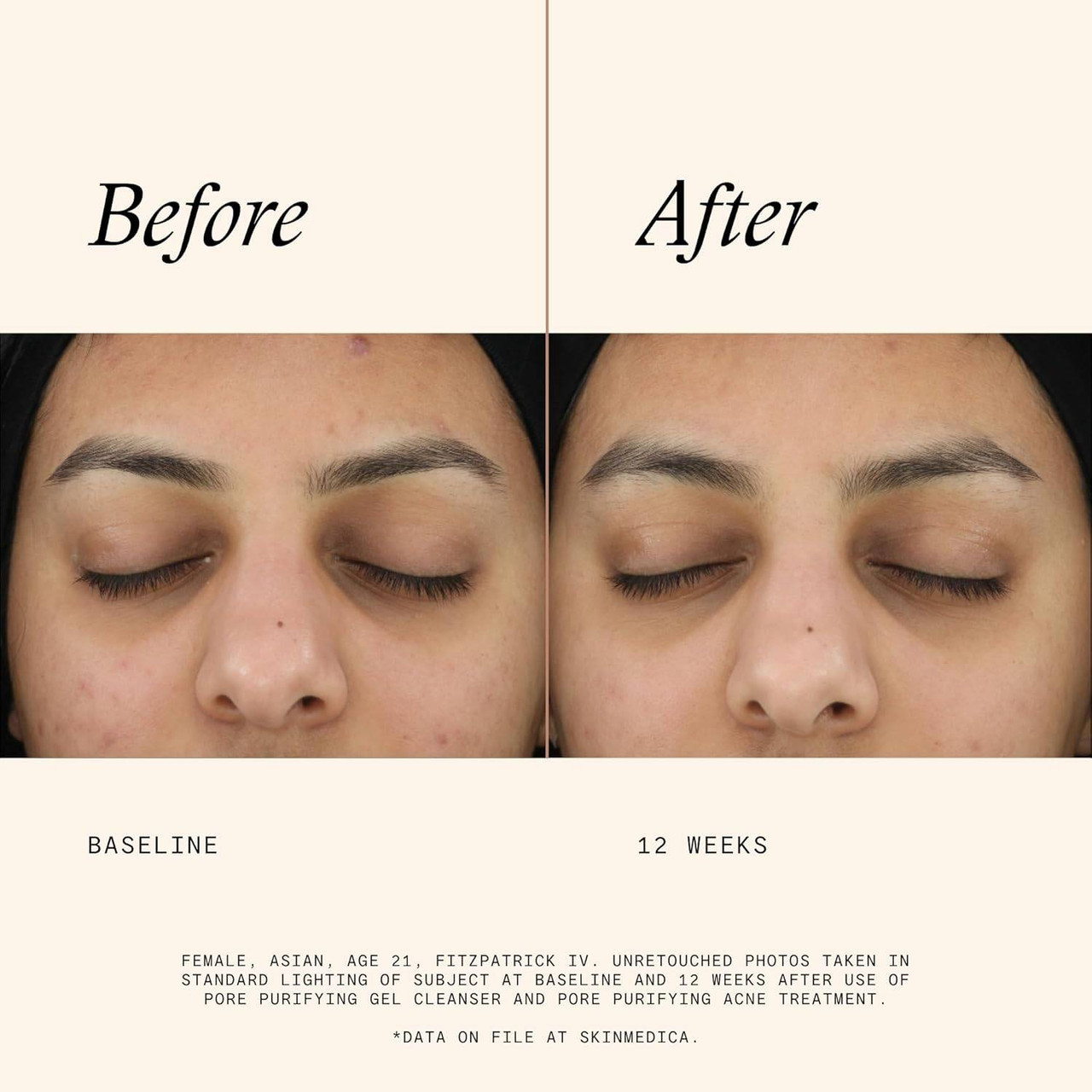 Before and after 12 weeks photos of a woman's face