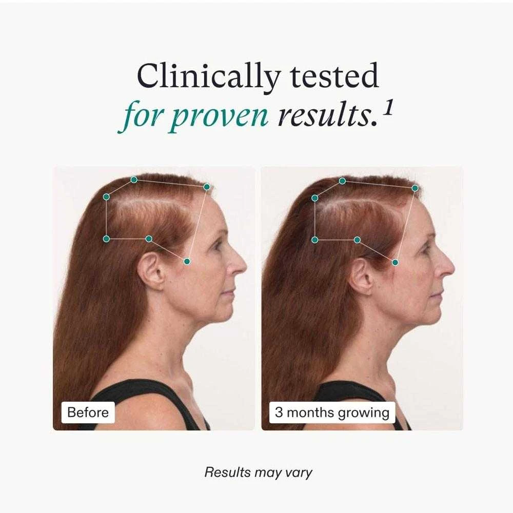 Nutrafol Women's Balance before and after 3 months hair growth photos