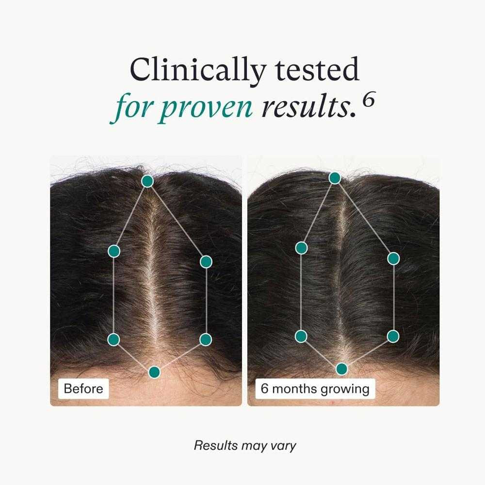 Nutrafol Women before and after 6 months hair part photos