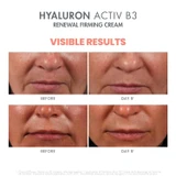 Before and day 5 photos of mouth and cheek wrinkles