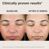 Baseline and after 12 weeks faces, clinically proven results