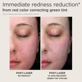 Post-laser redness with no product vs with UV Skin Recovery green tint applied