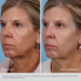 Baseline and after 6 weeks before and after photos of a woman using Claribright