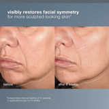 Before and after 8 weeks jawline photos from a NeuroTouch Symmetry Serum clinical test