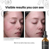 Before and after photos of a woman's cheek using Revision Radiance+ serum