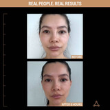 Before and after 8 hours on a woman's face, real people real results