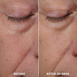 Before and after 30 days close-up of the under-eye area