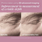 Before and after 10 minutes 3D imaging of under-eye skin