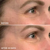Eye area before and after 30 days Bio-Renew EGF Eye Cream comparison