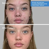 Acne serum face before and after 8 weeks clearer skin comparison