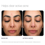 PCA Skin Acne Control Prebiotic Gel Cleanser
