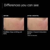 Before and after 4 months photos of skin texture with C-Quench