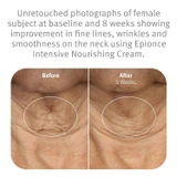 epionce Intensive Nourishing Cream before and after 8 weeks neck photos