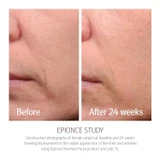 epionce Renewal Facial Lotion before and after 24 weeks cheek photos