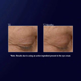 Eye wrinkles at T0 and at 12 months comparison photos