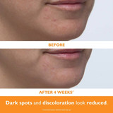 Before and after 4 weeks of chin and mouth area, dark spots look reduced