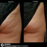 Baseline and 4-week photos of the back of a thigh