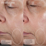 HydraFirm before and after 12 weeks side-face photos with circled areas