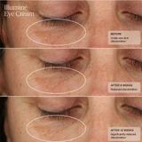 Before, after 8 weeks and after 12 weeks photos of under-eye discoloration