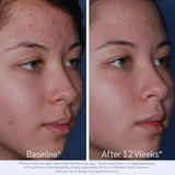Obagi CLENZIderm before and after 12 weeks acne photos, female profile