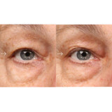 Before and after close-up of eye area with reduced under-eye puffiness