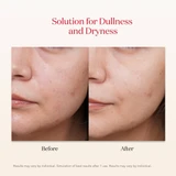 Before and after photos of a cheek
