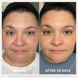 Before and after 30 days photos of a woman's face using glo Skin Beauty Renew Serum