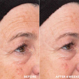 Before and after 4 weeks photos of the eye area
