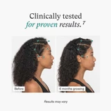 Hairline before and after 6 months, clinically tested for proven results