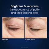 Baseline and 12-week photos of the under-eye area