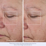 Eye area wrinkles at baseline and after a single application, close-up