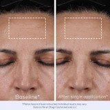 Forehead at baseline and after a single application