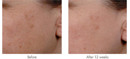 nia24-rapid-depigmentation-serum-before-and-after-.jpg nia24-rapid-depigmentation-serum-before-and-after-.jpg