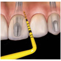 Colorvue Periodontal Probe Promo Kit Single End #6 Yellow Kit (PCVNCKIT12)