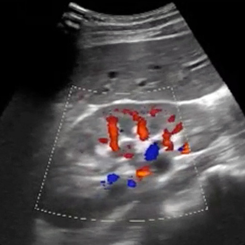 Renal Anatomy Ultrasound - Kidney, Ureters Ultrasound Training