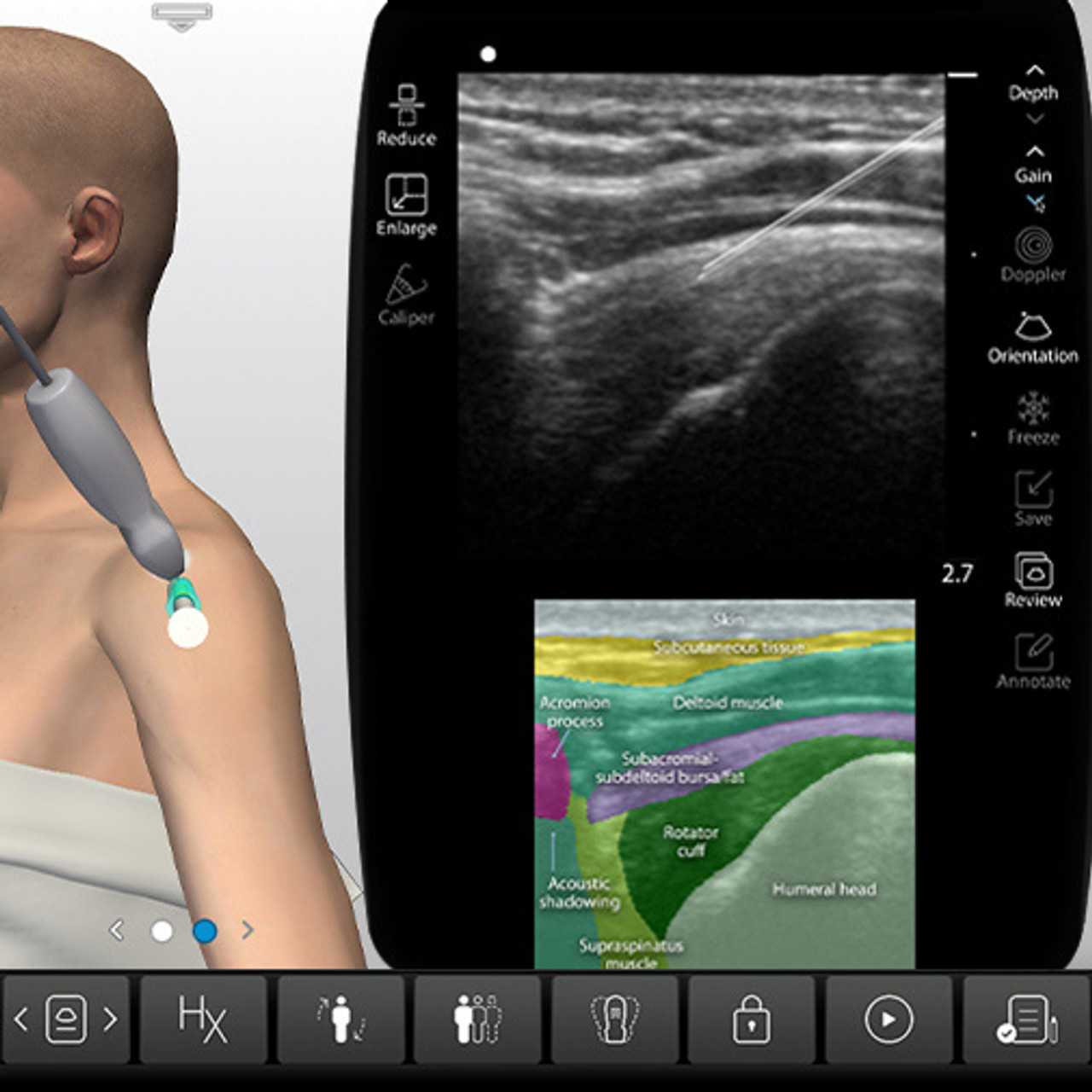 Subacromial Injection Subacromial Shoulder Injection Ultrasound