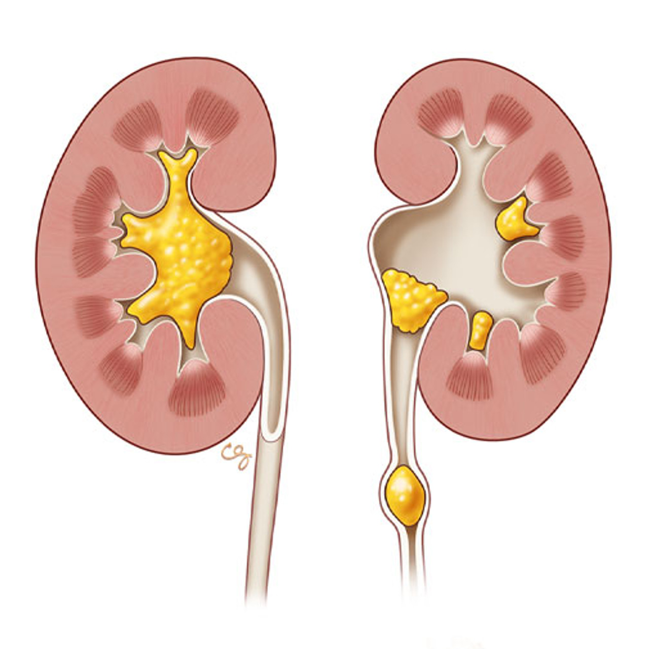 Renal Ultrasound - Online Clinical Renal Ultrasound Course