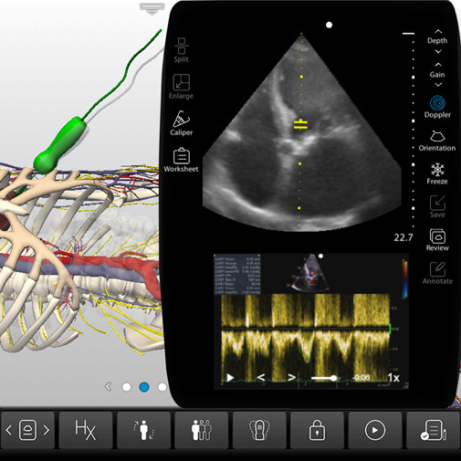 Focus Ultrasound Exam - Focused Cardiac Ultrasound Emergency
