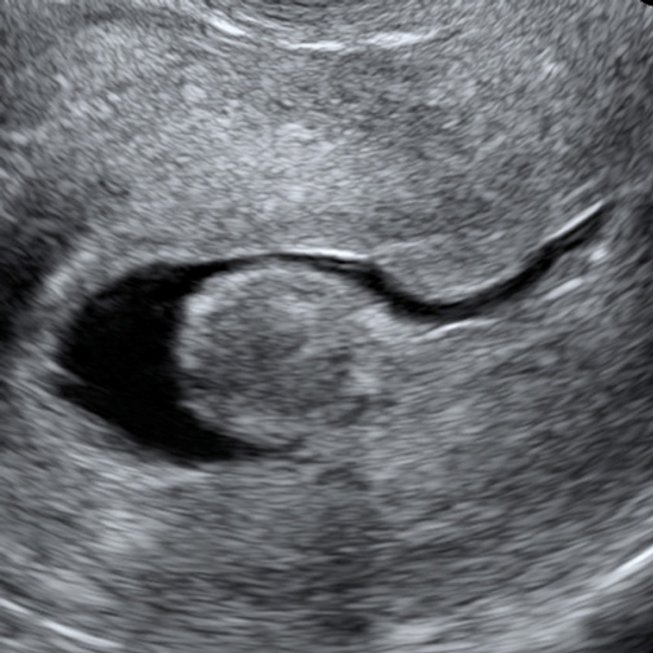 abnormal transvaginal ultrasound