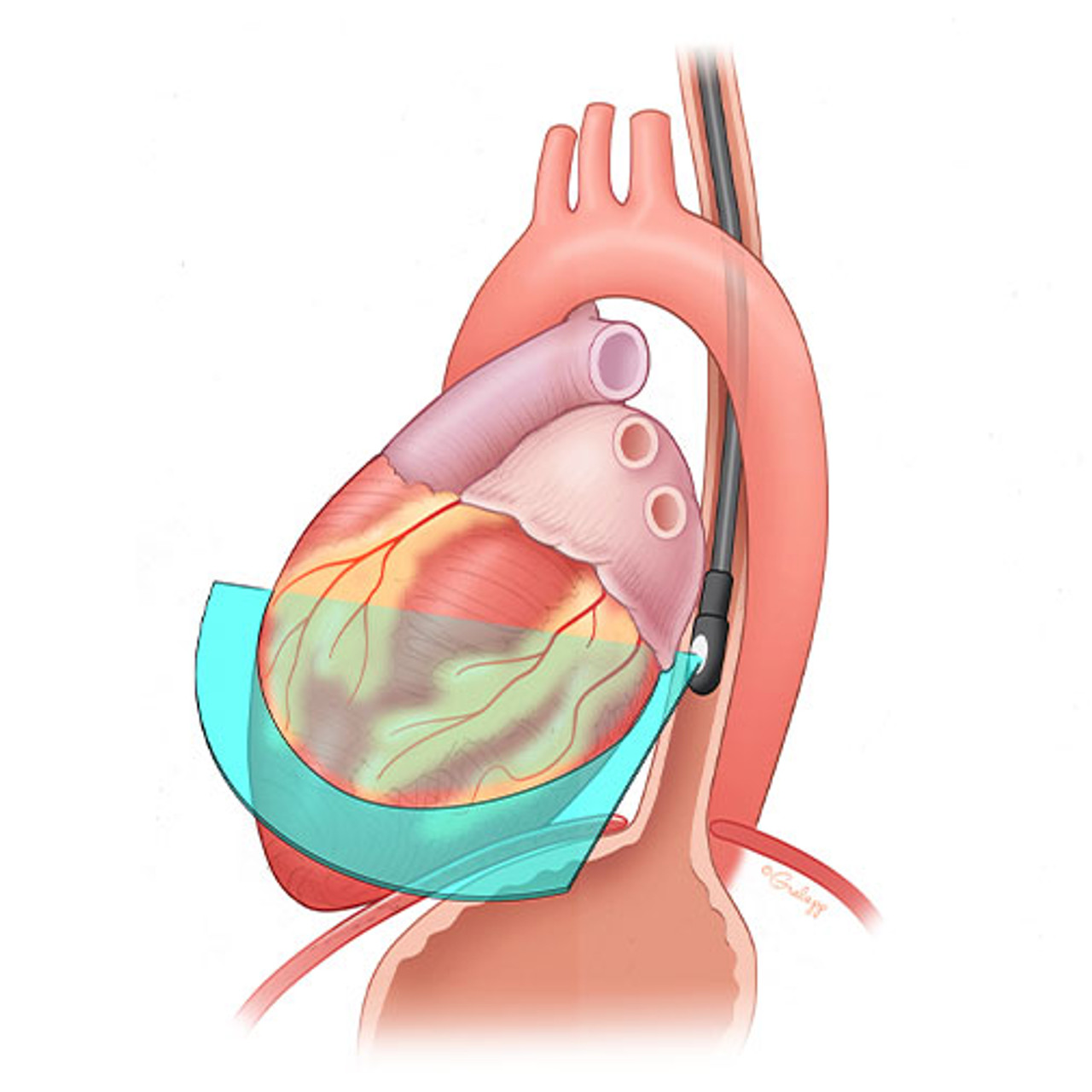 Transesophageal Echocardiogram TEE - Resuscitative TEE Ultrasound