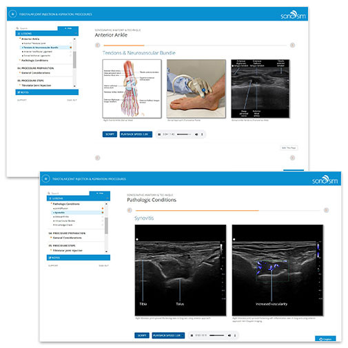 Tibiotalar Joint Effusion UltrasoundGuided Injection Training