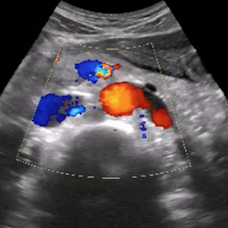 Ultrasound Training - Inferior Vena Cava (IVC) and Aorta Anatomy