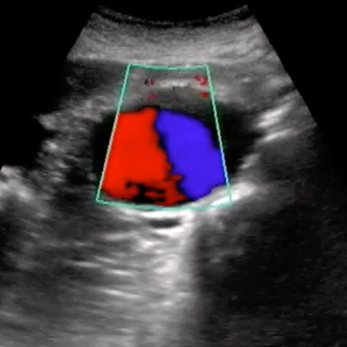 Aorta IVC ultrasound training - SonoSim